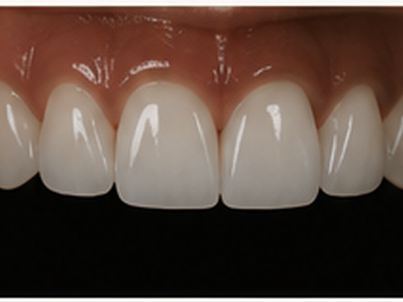 Porcelain Veneers